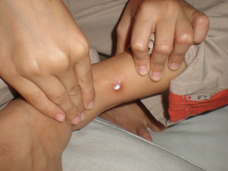 cush-wound-on-leg Wound on leg sprayed with hydrogen peroxide