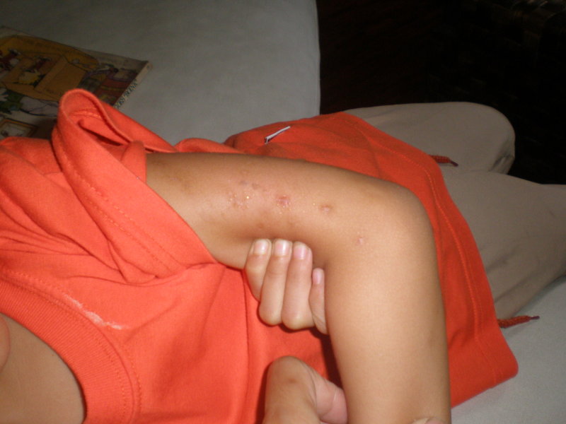 cush-wounds-on-arm Wounds on left arm