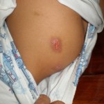 mish-eczema-butt-2008 mish-eczema-butt-2008
