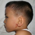 mish-eczema-ear-2008 mish-eczema-ear-2008