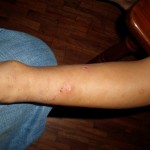 mish-eczema-leg-2008 mish-eczema-leg-2008