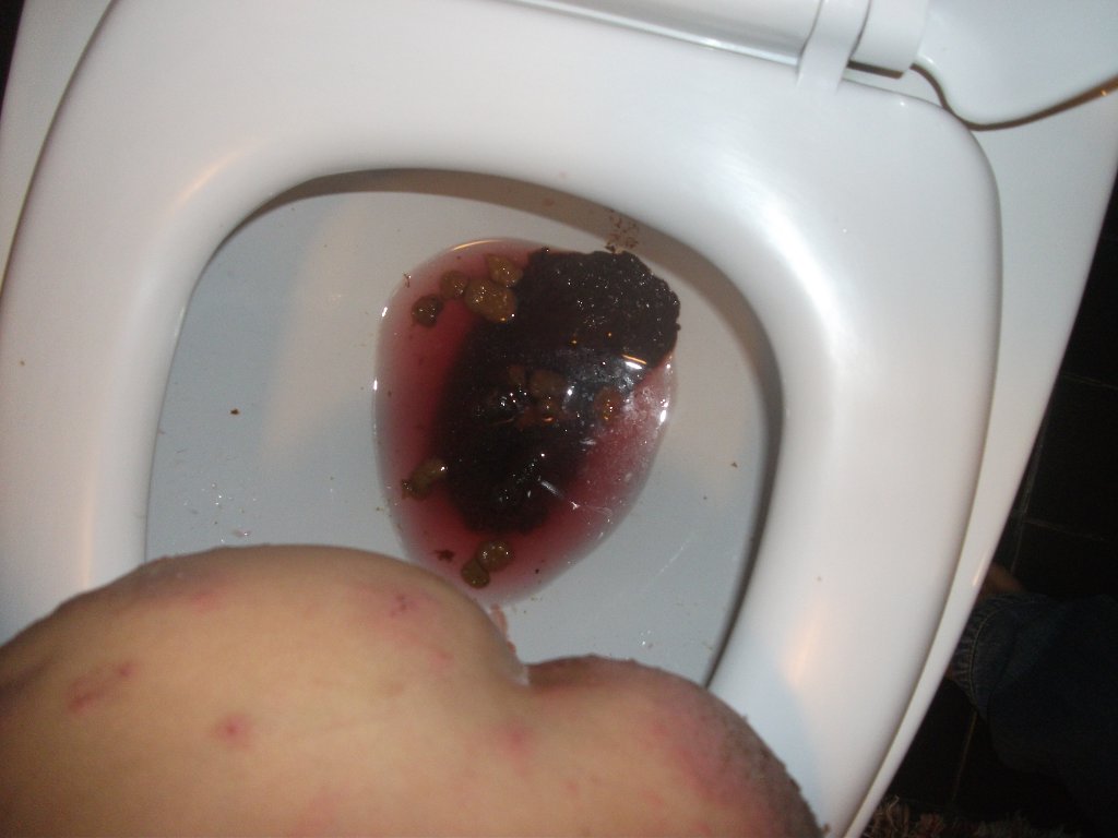 eczema-cure-hardpoop-redsludge